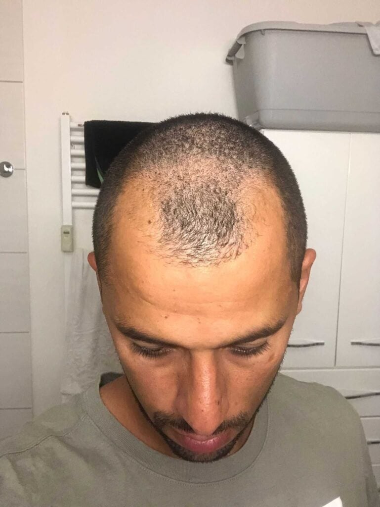 صورة كريم رفيع قبل زراعة الشعر في اليت هير