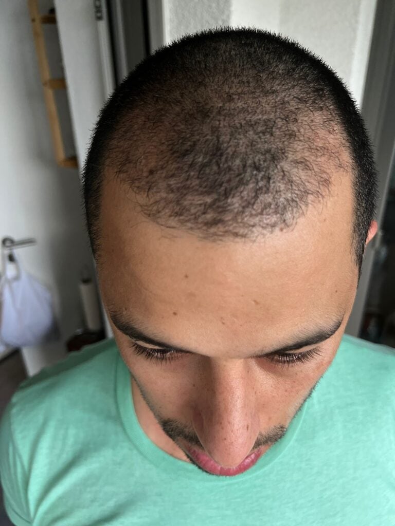 كريم رفيع بعد شهرين من زراعة الشعر في اليت هير