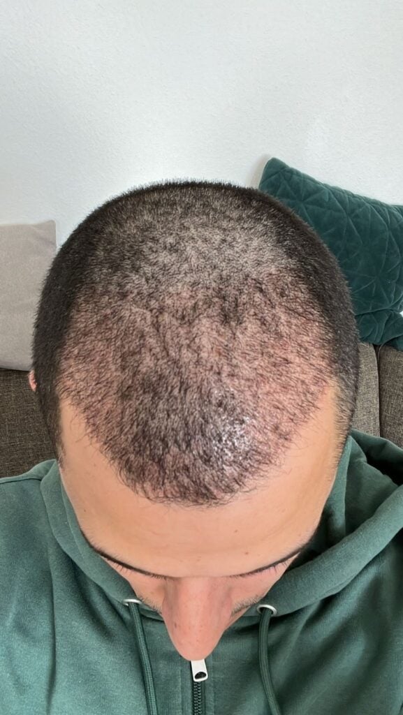 كريم رفيع بعد شهر من زراعة الشعر في اليت هير