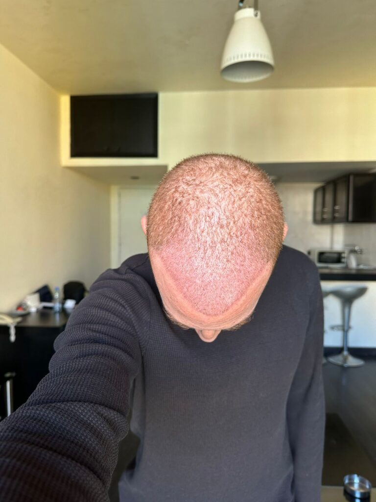 بعد زراعة الشعر في مشفى اليت هير