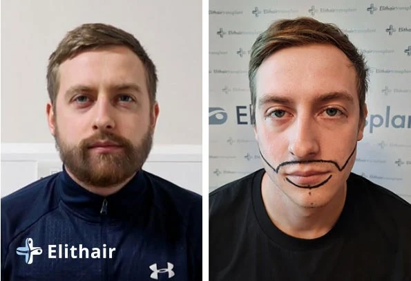 زراعة اللحية قبل وبعد للسيد جاي  - مشفى اليت هير لزراعة الشعر