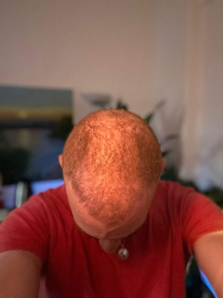 نتائج زراعة الشعر بعد 3 اشهر في مشفى اليت هير