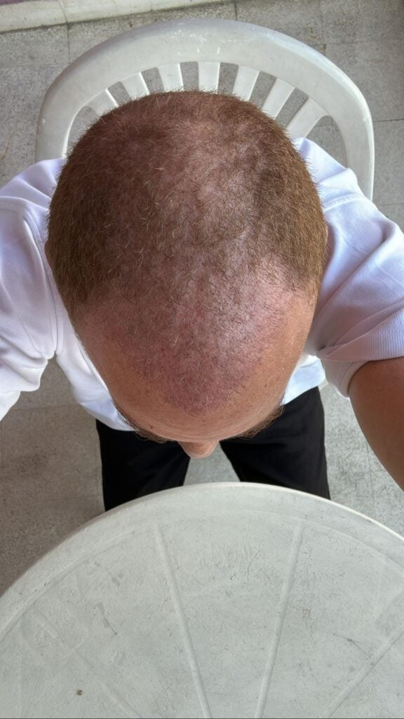 نتائج زراعة الشعر بعد شهر في مشفى اليت هير