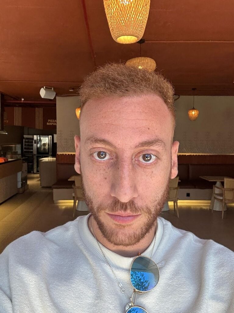 نتائج زراعة الشعر بعد 12 شهر في مشفى اليت هير