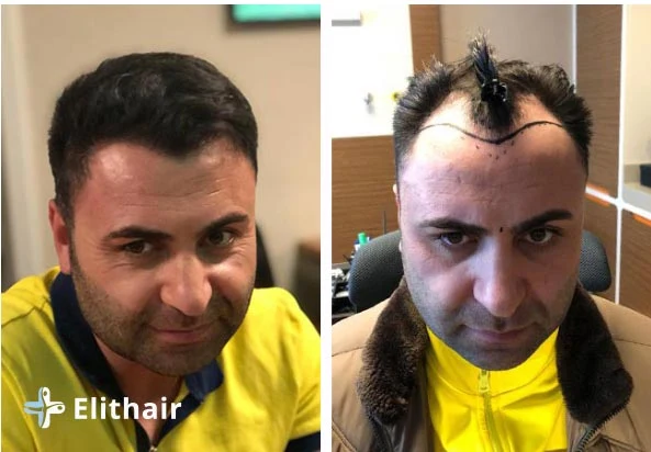 زراعة الشعر قبل وبعد للسيد مراد - مشفى اليت هير لزراعة الشعر