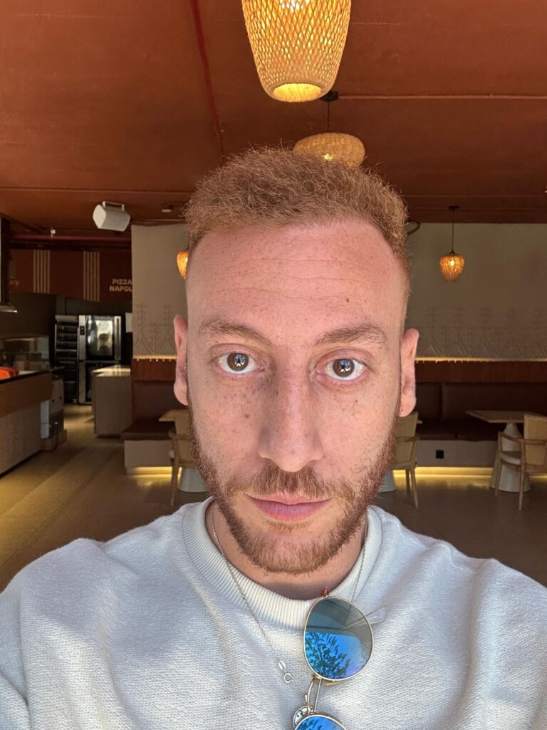 بعد عام من زراعة الشعر في مشفى اليت هير