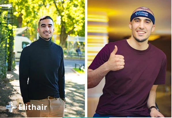 زراعة الشعر قبل وبعد للسيد عصام - مشفى اليت هير لزراعة الشعر