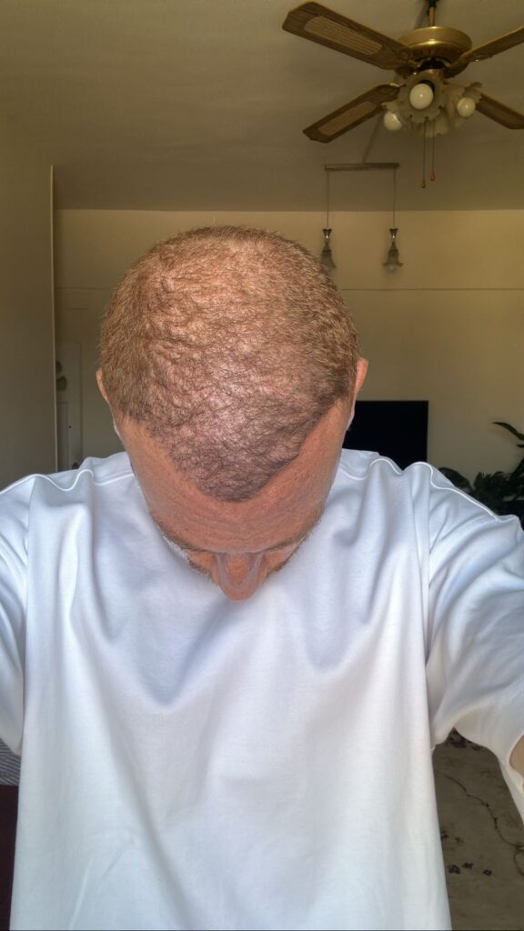 بعد 4 أشهر من زراعة الشعر في مشفى اليت هير