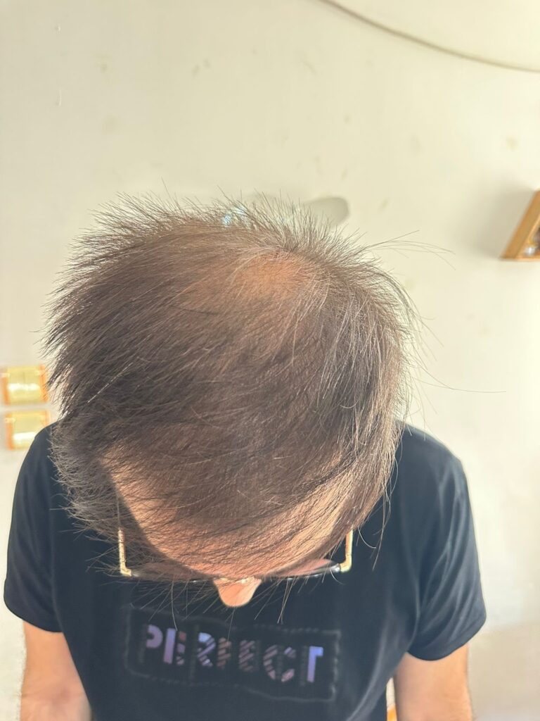 ما قبل زراعة الشعر في مشفى اليت هير