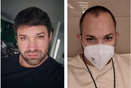 قبل وبعد زراعة الشعر في دبي 