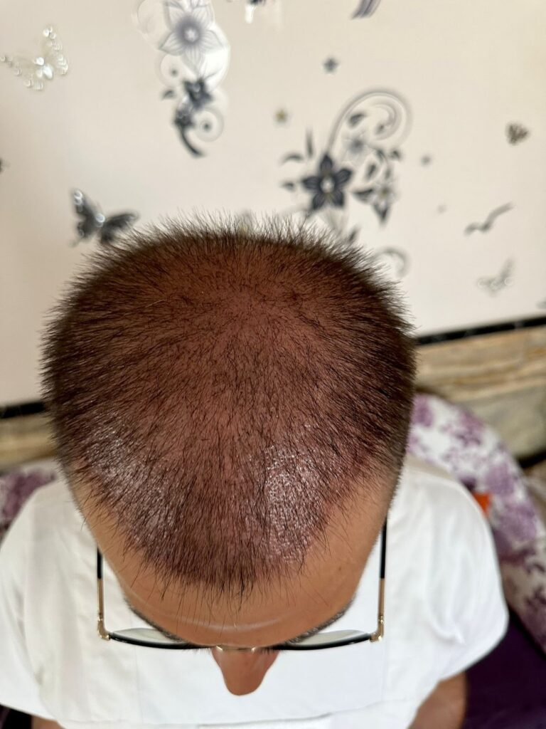 أسبوعين بعد زراعة الشعر - مركز اليت هير لزراعة الشعر