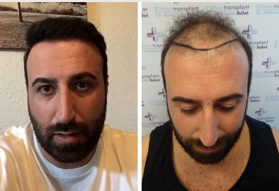 قبل وبعد زراعة الشعر في دبي 