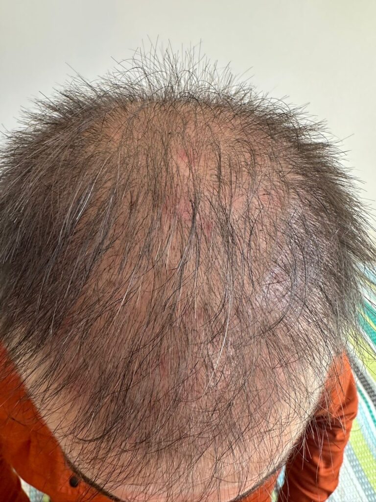 الشهر 3 بعد زراعة الشعر في مشفى اليت هير