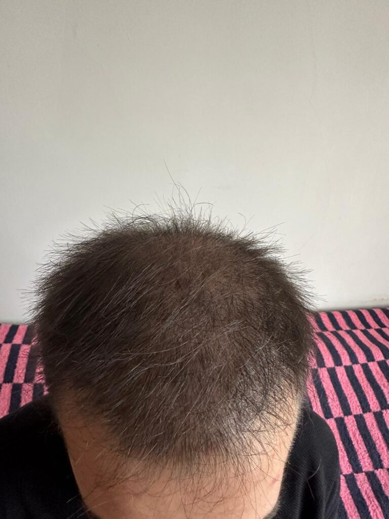 6 أشهر بعد زراعة الشعر - مركز اليت هير لزراعة الشعر