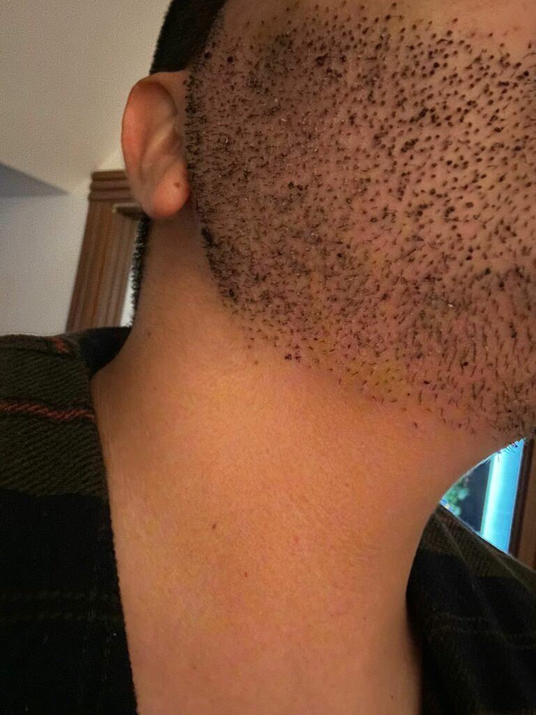 الاسبوع الأول بعد زراعة اللحية - مركز اليت هير