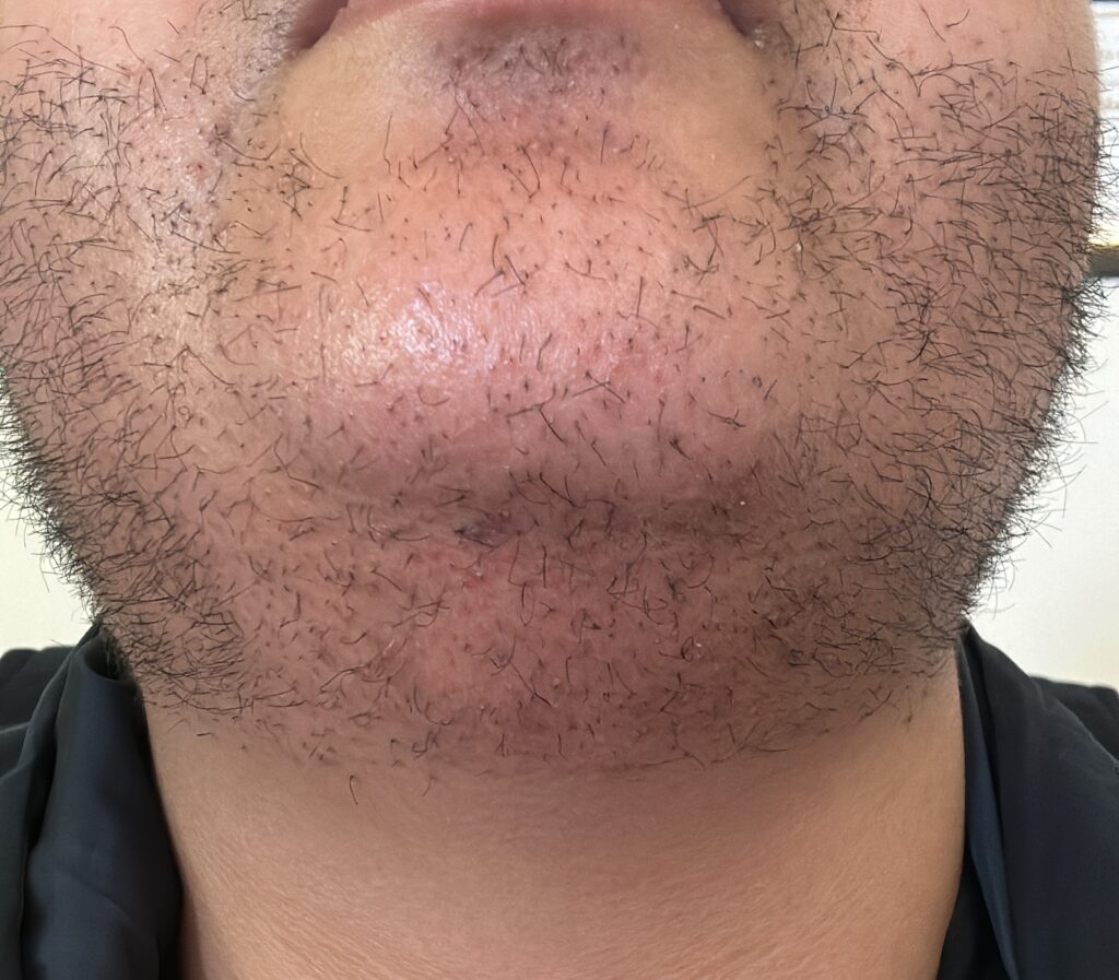 الشهر الأول بعد زراعة اللحية - مركز اليت هير