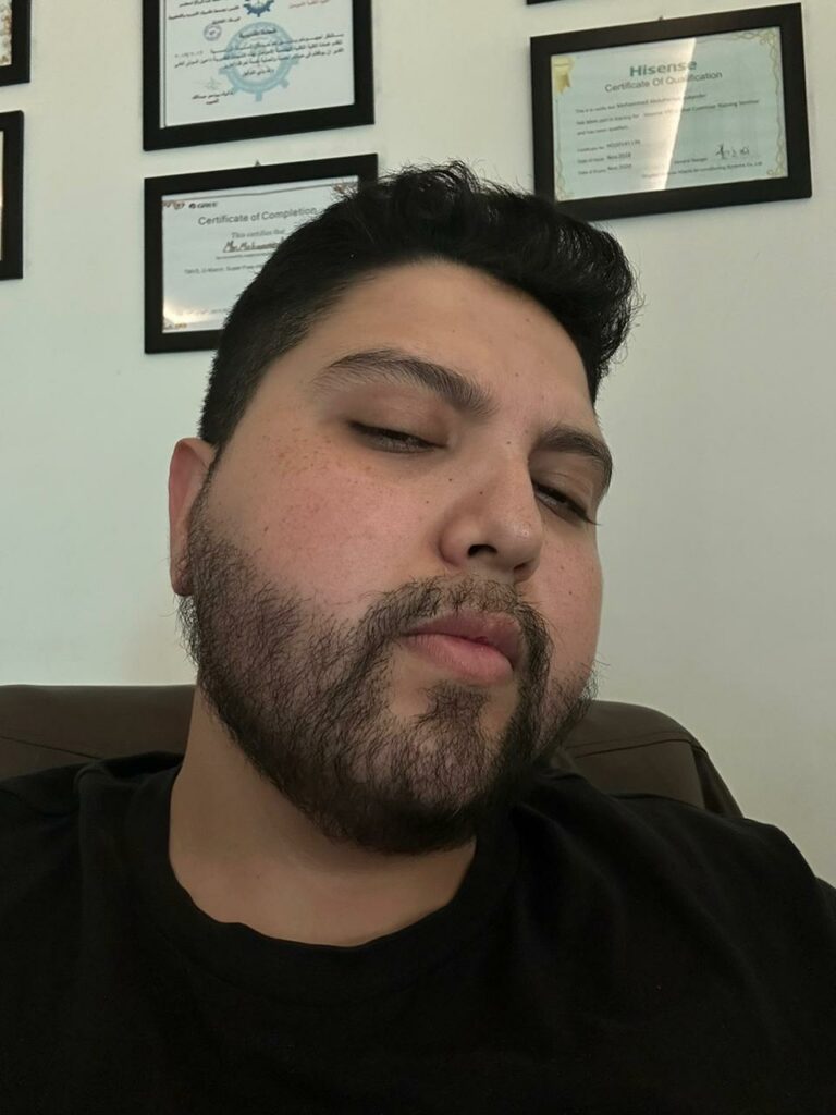 بعد 6 أشهر من زراعة اللحية - مركز اليت هير لزراعة الشعر