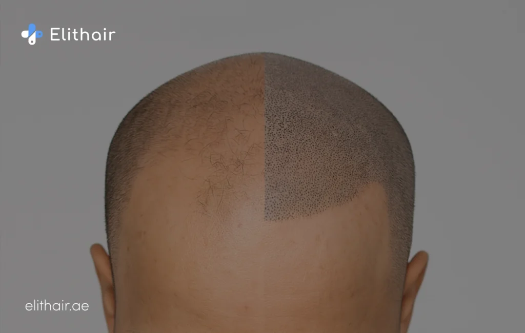 تقنية SMP مركز اليت هير لزراعة الشعر