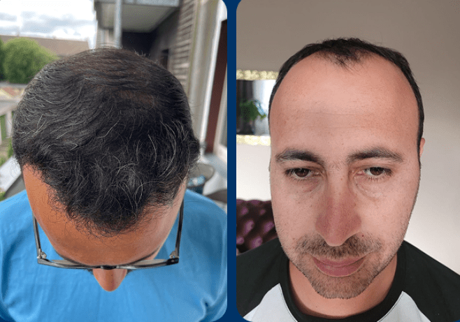 نتائج زراعة الشعر قبل وبعد في مشفى اليت هير