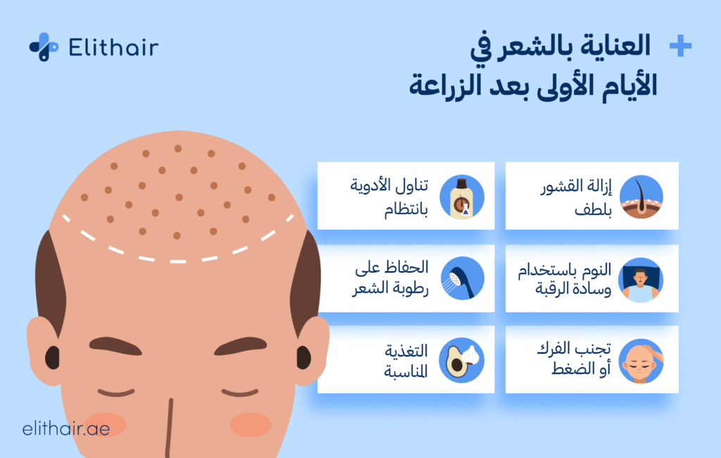 العناية بالشعر في الأيام الأولى بعد الزراعة - مشفى اليت هير لزراعة الشعر