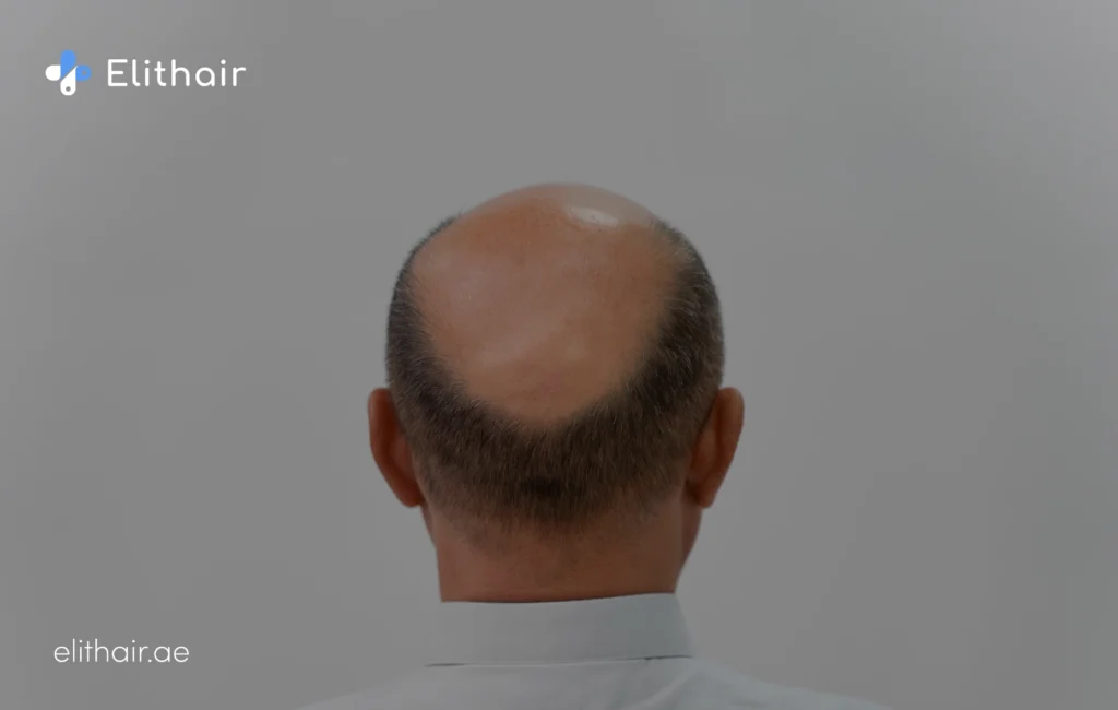 المنطقة المانحة - مركز اليت هير لزراعة الشعر
