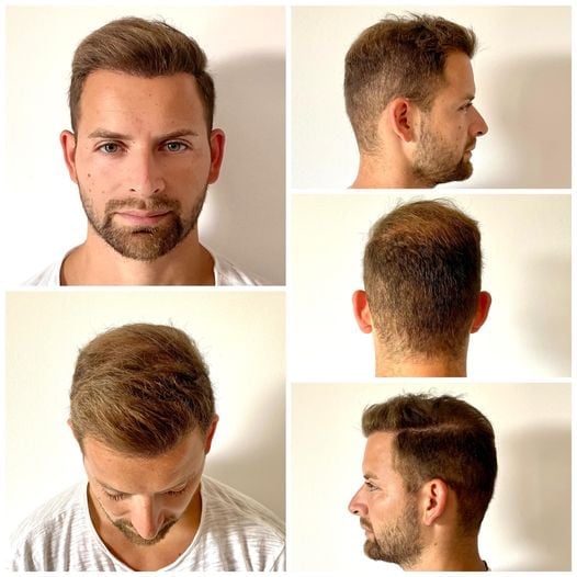 افضل نتائج زراعة الشعر