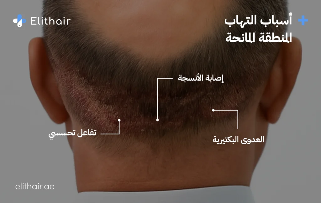 التهاب المنطقة المانحة - مركز اليت هير لزراعة الشعر