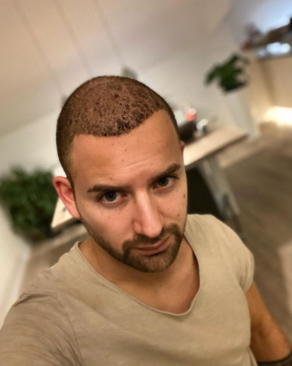 مراحل نمو الشعر المزروع بالصور بعد شهر من زراعة الشعر