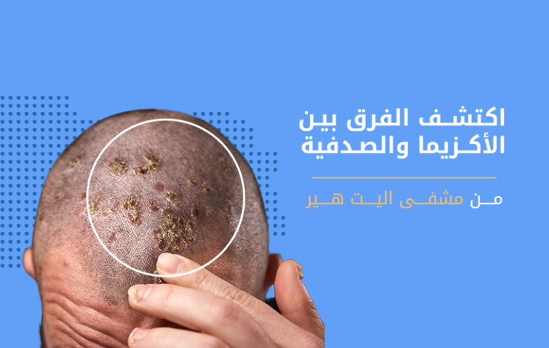 الفرق بين الاكزيما والصدفية