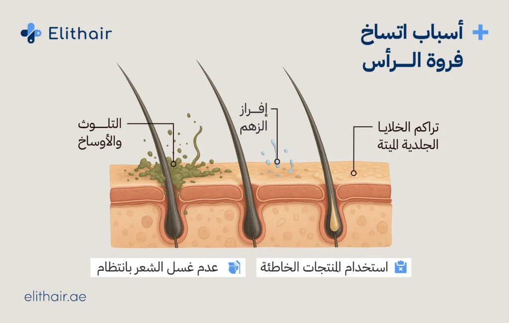 أسباب اتساخ فروة الرأس - مركز اليت هير لزراعة الشعر