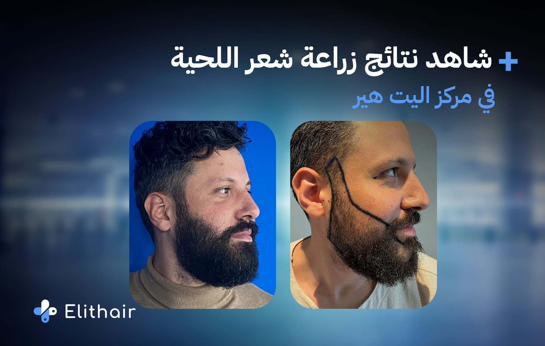 طرق تكيثف شعر اللحية - مركز اليت هير لزراعة الشعر