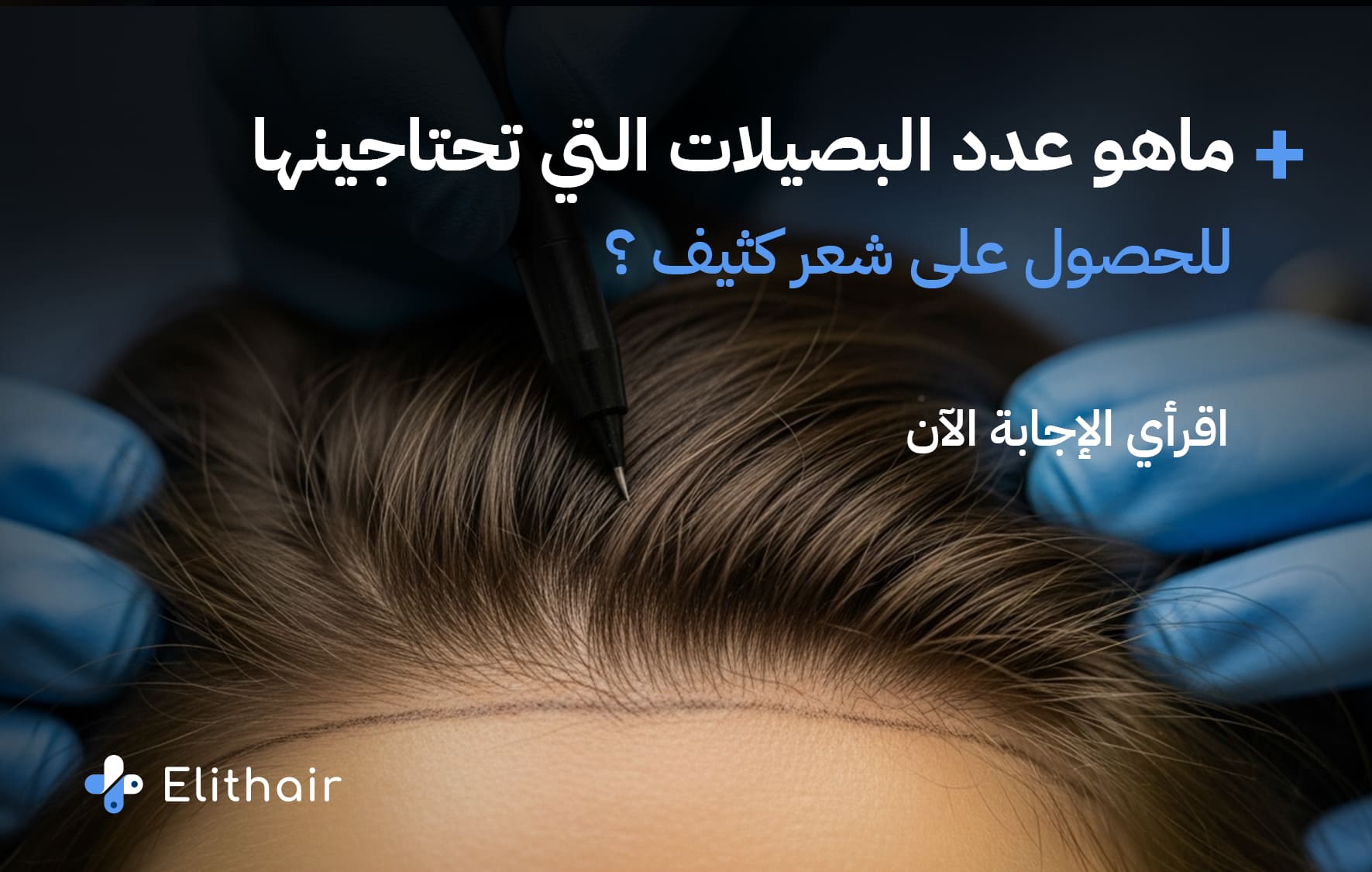 زراعة مقدمة الراس للنساء | ما هو الحد الأقصى لاقتطاف البصيلات؟