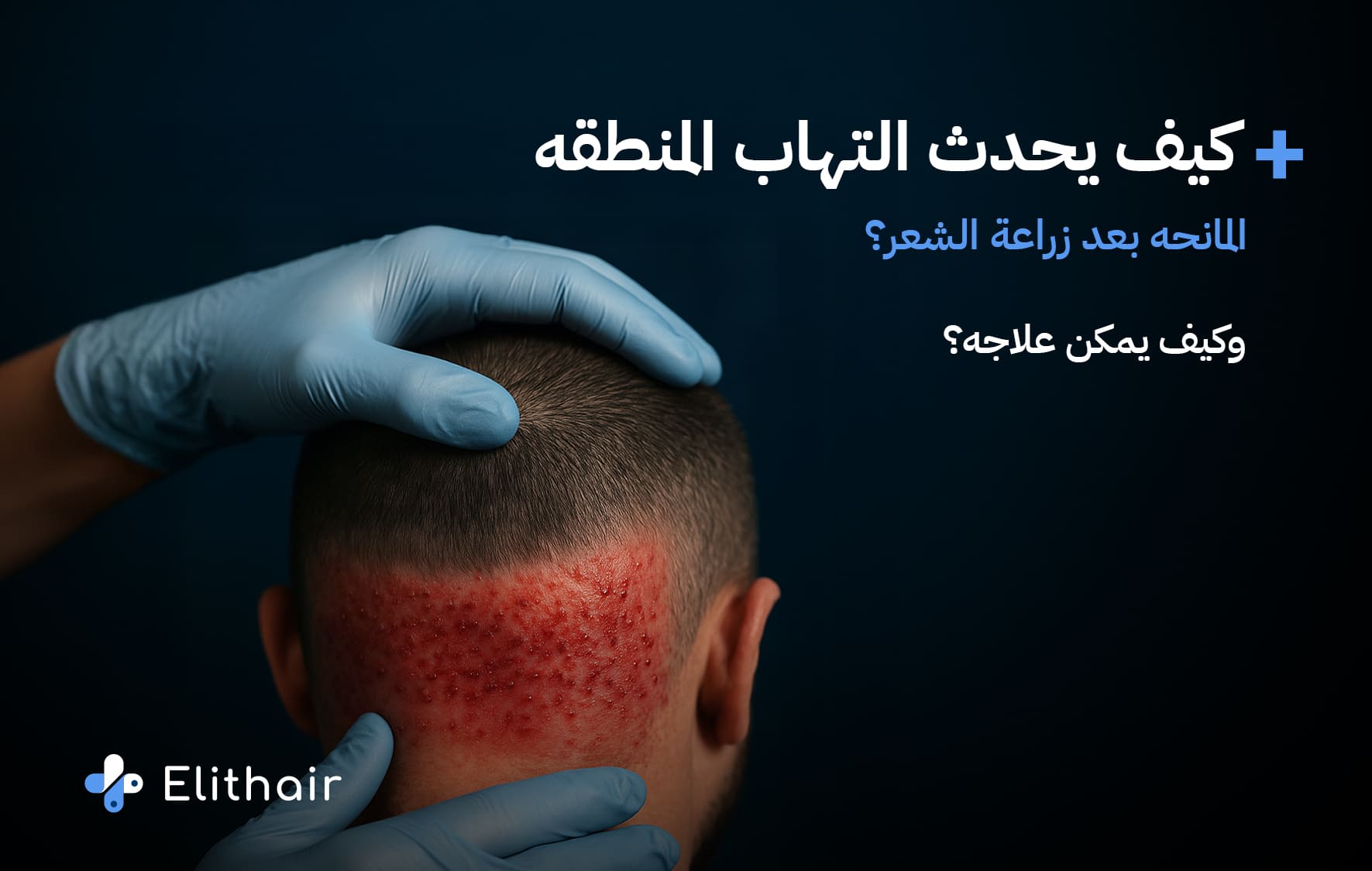 التهاب المنطقة المانحة بعد زراعة الشعر