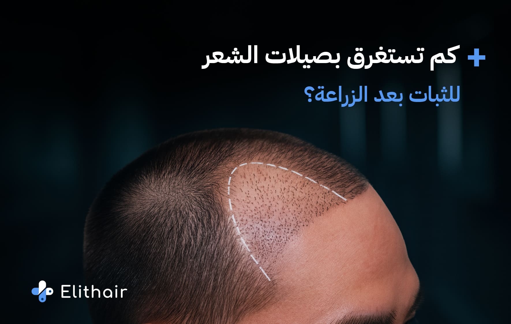 كم تستغرق بصيلات الشعر للثبات بعد الزراعة؟