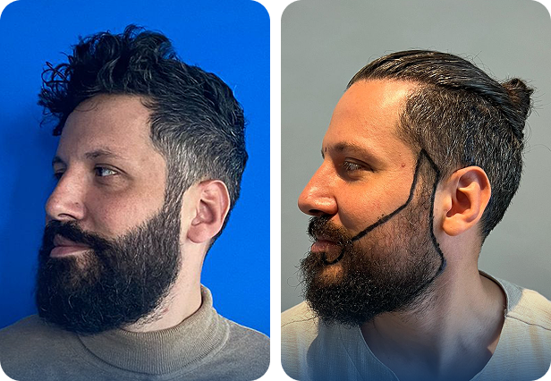 أفضل مركز زراعة شعر في تركيا