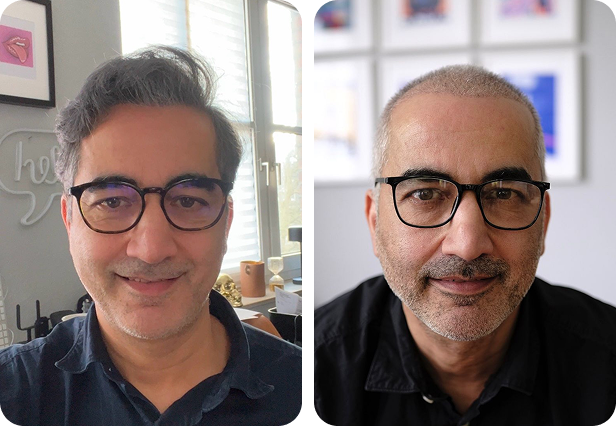 تجربتي مع زراعة الشعر في تركيا