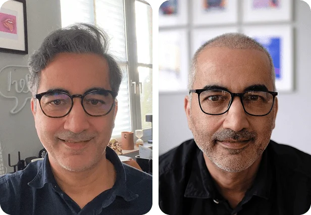 نتائج زراعة الشعر للسيد أفسار في مركز اليت هير