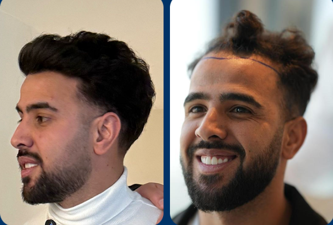 زراعة الشعر للسيد موسى - مركز اليت هير لزراعة الشعر