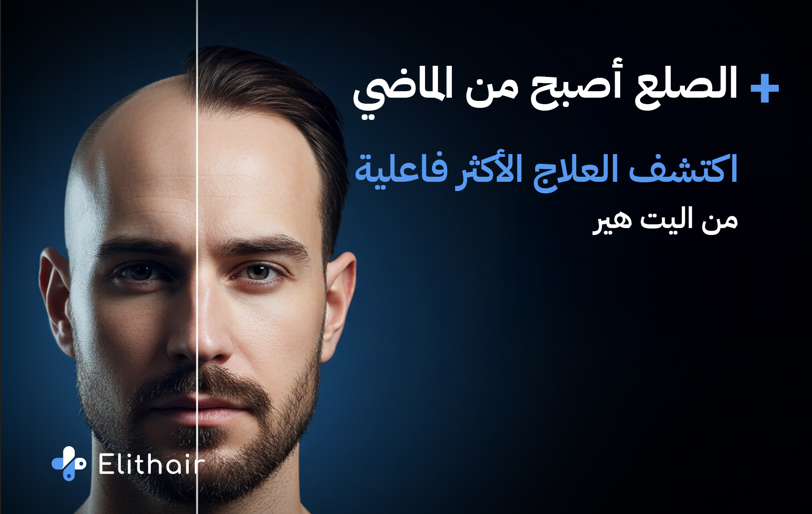 أفضل علاج للصلع وتساقط الشعر