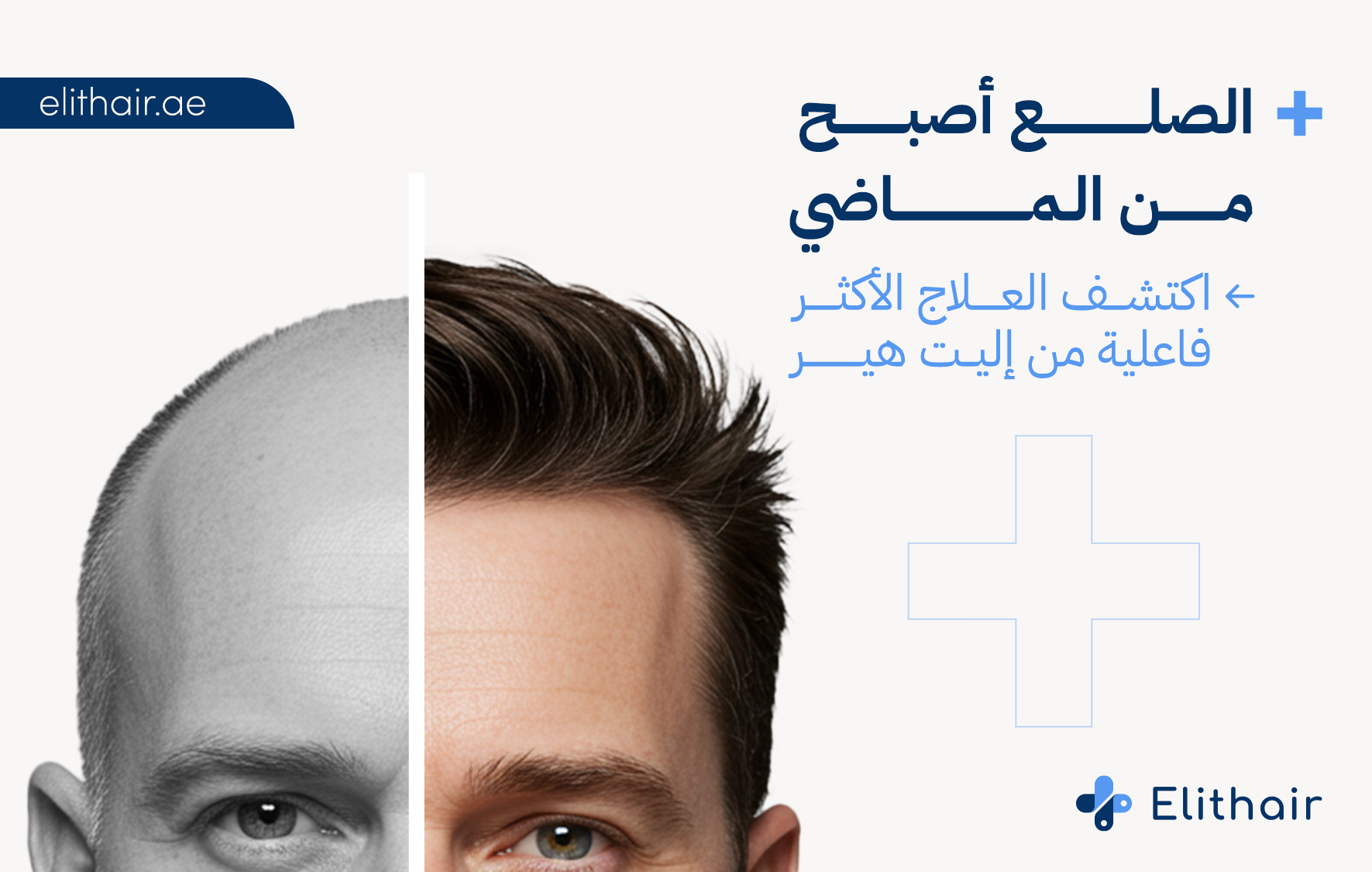 أفضل علاج للصلع وتساقط الشعر