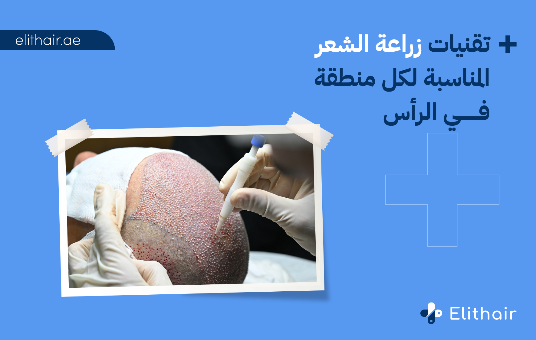 تقنيات زراعة الشعر - مركز اليت هير لزراعة الشعر