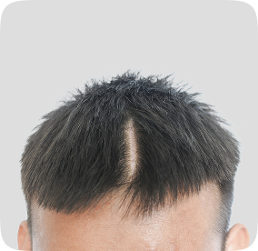 زراعة الشعر في أماكن الندبات والحروق