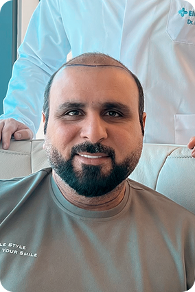 قبل زراعة الشعر وحقن البلازما