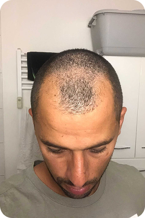 قبل زراعة الشعر، زراعة الشعر للرجال