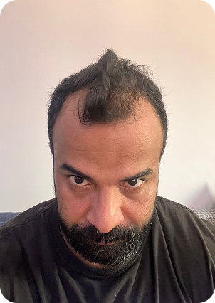 قبل وبعد زراعة الشعر في تركيا