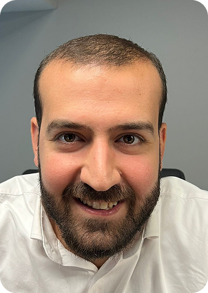 قبل زراعة الشعر في تركيا