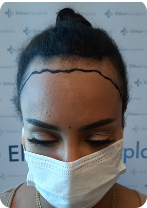 قبل وبعد زراعة الشعر للنساء في تركيا