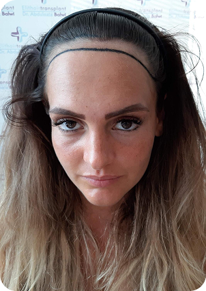 قبل وبعد زراعة الشعر للنساء في تركيا