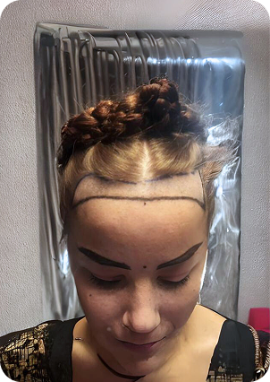 قبل وبعد زراعة الشعر للنساء في تركيا