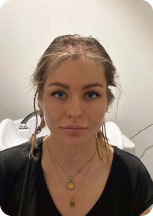 قبل وبعد زراعة الشعر للنساء في تركيا